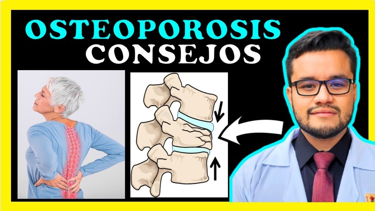 ✅ OSTEOPOROSIS* | ¿TIENES OSTEOPOROSIS? ¿Cuál ES EL MEJOR TRATAMIENTO? - DENSITOMETRIA OSEA