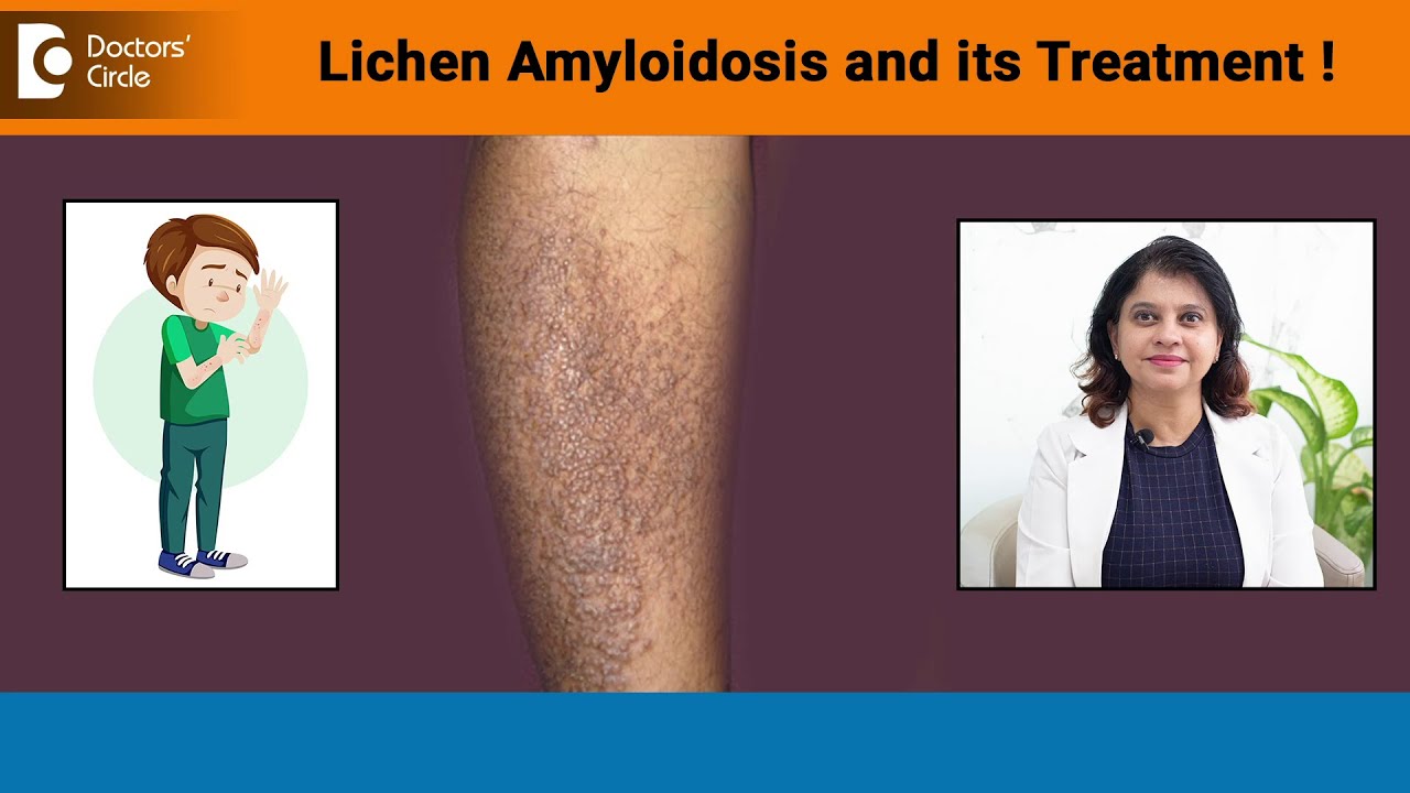 Brownish red bumps on hands, legs| LICHEN AMYLOIDOSIS & its Treatment-Dr Amee Daxini|Doctors' Circle