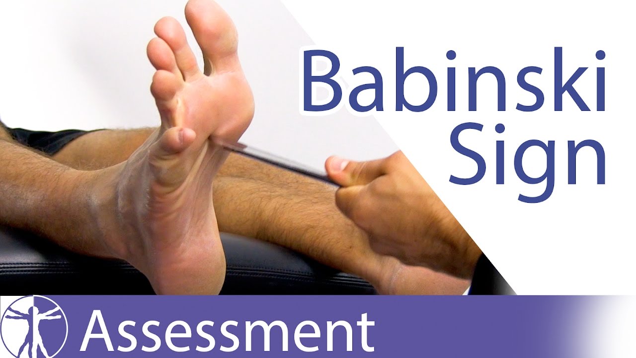Знак Бабинского или рефлекс | поражение верхнего двигательного нейрона