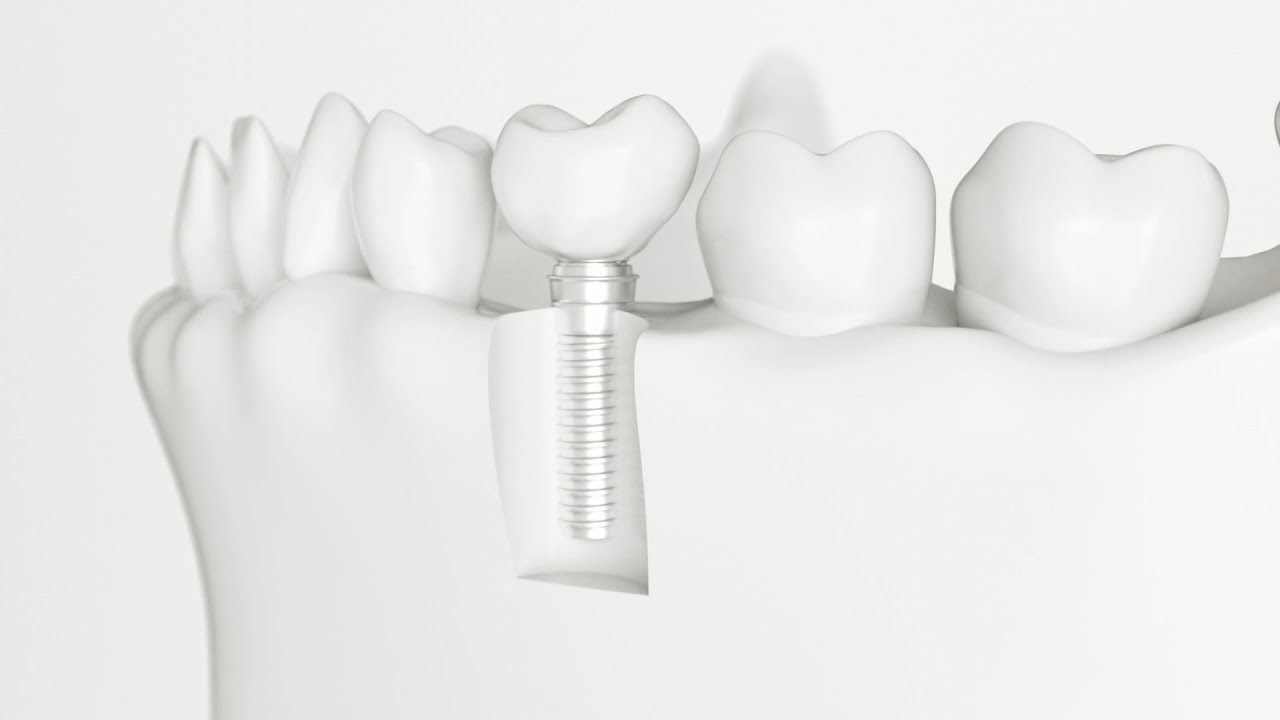 Dental Implants at Lowry Advanced Dentistry (Denver CO Dentist)