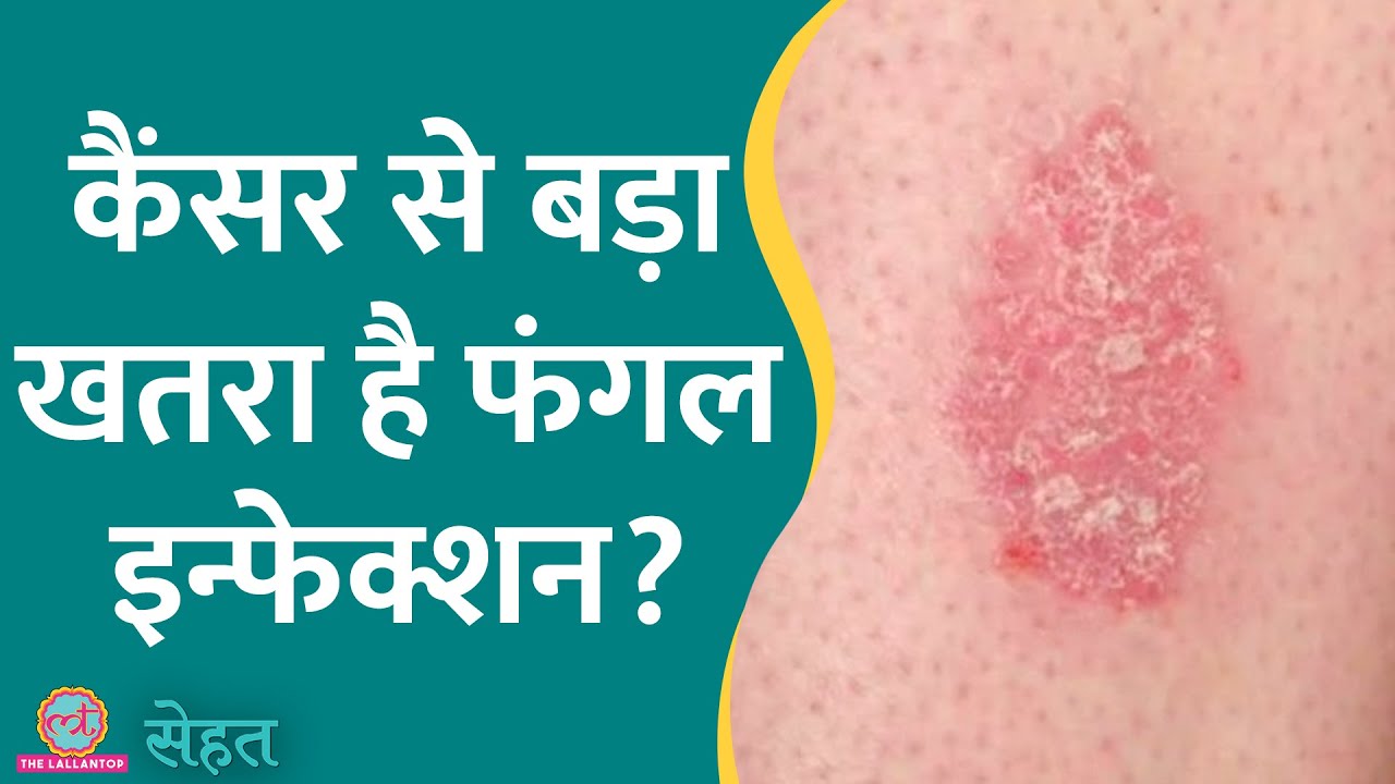 WHO ने कहा Fungal Infection दुनिया के लिए सबसे बड़ा ख़तरा, जानिए क्यों | Sehat ep 568