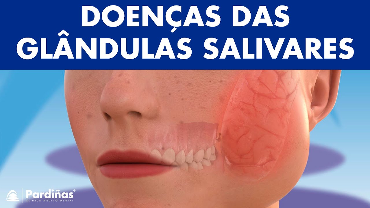 CAXUMBA e outras doen&ccedil;as das gl&acirc;ndulas salivares: mucocele, sialadenite, sialolit&iacute;ase &copy;
