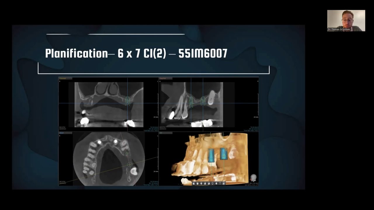 Webinar with Dr. Thomas Dougnac : Implantologie minimalement invasive a propos d'un cas.