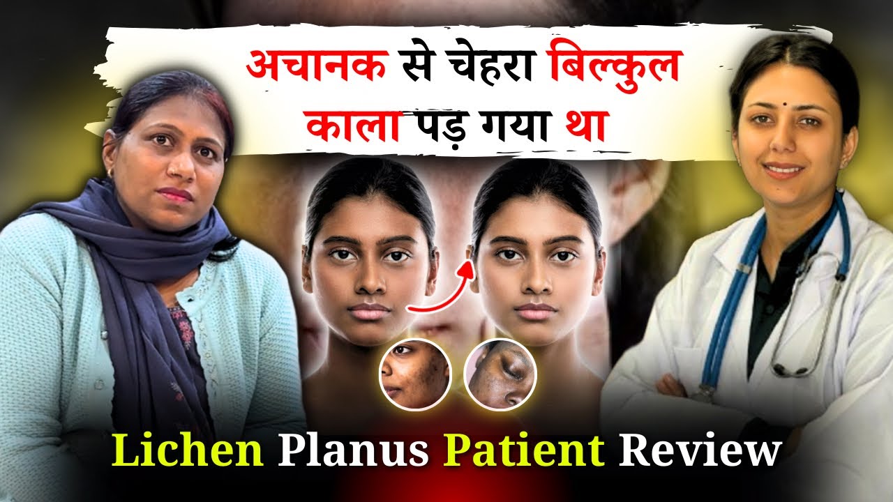 Lichen Planus का 100% Permanent इलाज | चेहरा बिल्कुल काला पड़ गया था | Dr. Upasana Patient Review