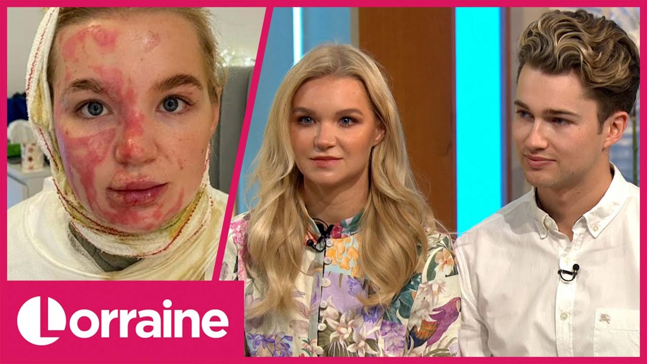 AJ Pritchard's Girlfriend Abbie Talks About Suffering 3rd Degree Burns After Video Went Wrong | LK