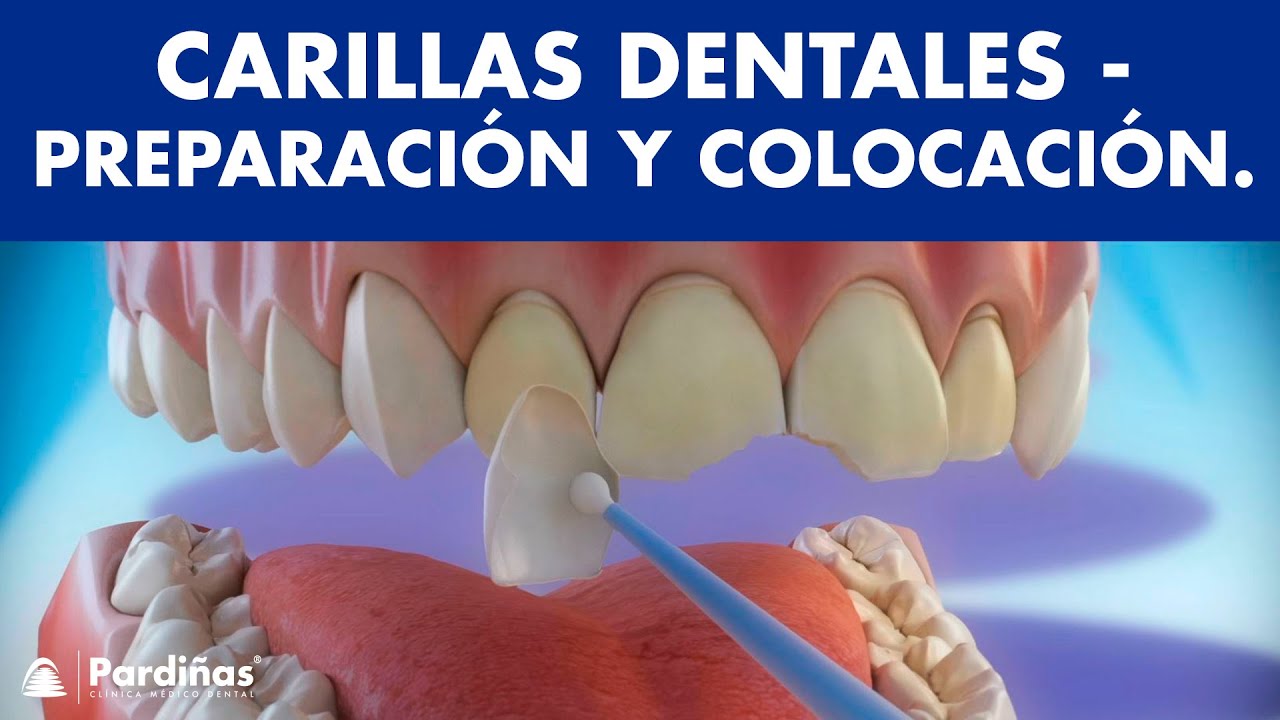 Carillas dentales - ¿Cómo se preparan y se colocan? Porcelana y resina o composite ©