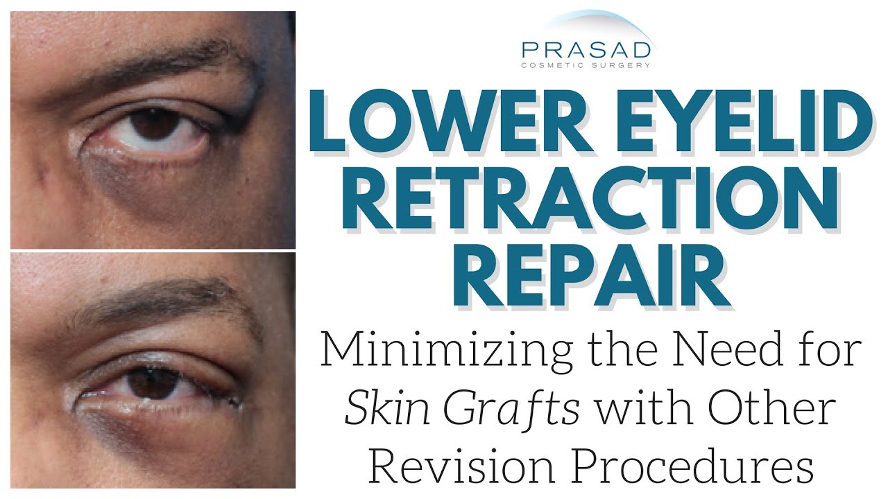How Skin Grafts are Avoided or Minimized in Eyelid Retraction Repair Surgery