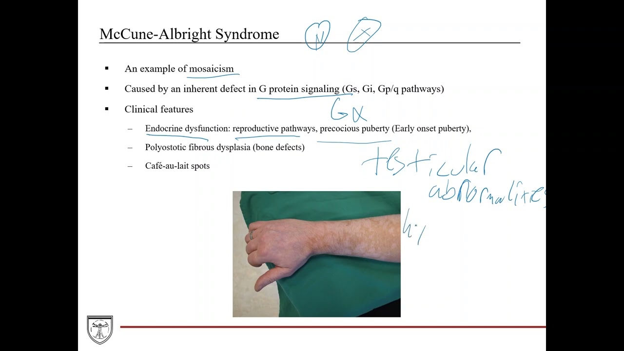 Mosaicism, McCune-Albright, Albinism, and Tyrosinosis [Genetics 8 of 8]