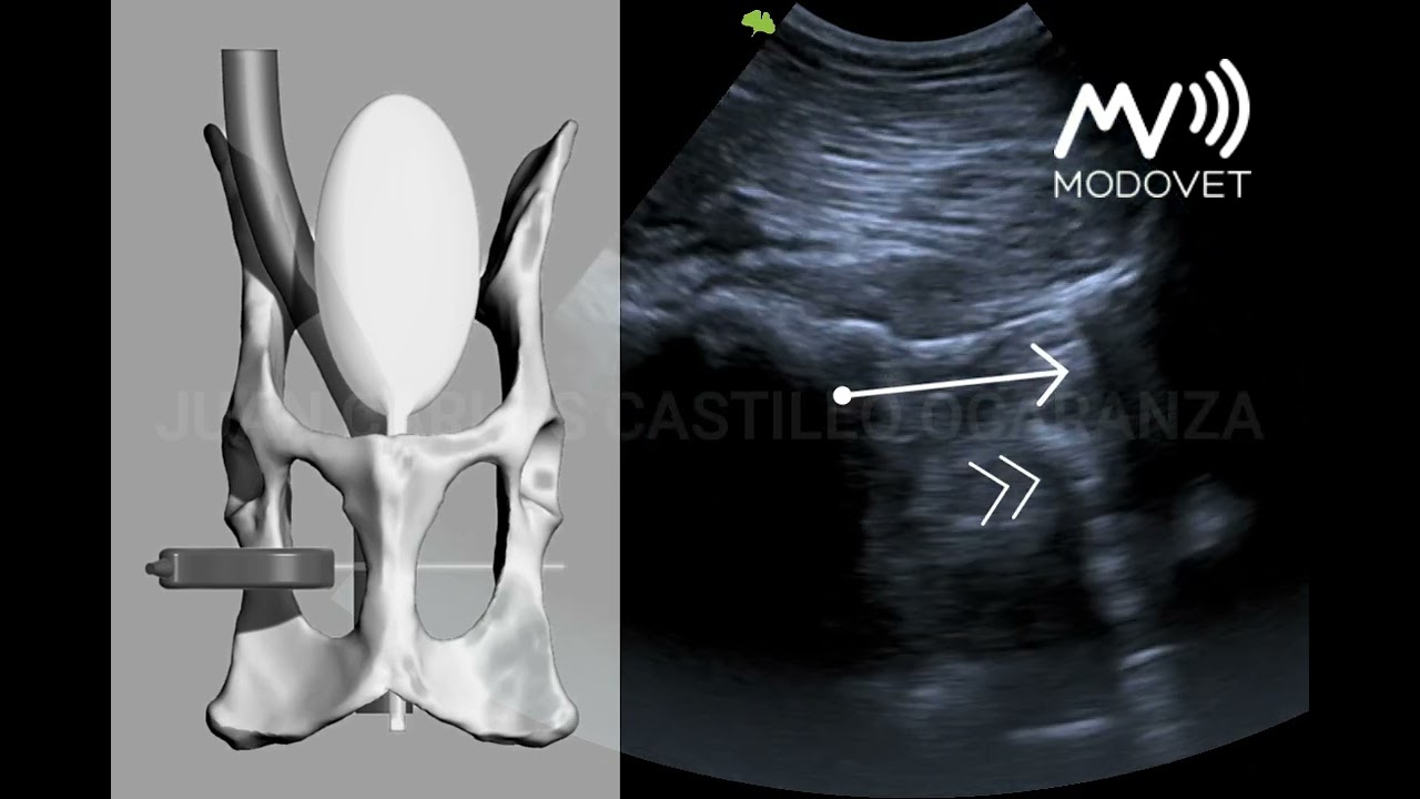 Técnica ecográfica - Abordaje Trans Foramen Obturador (TFO)
