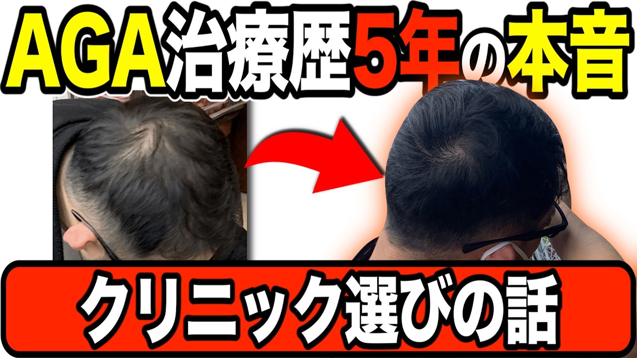 【2025年版】AGAクリニックおすすめ解説【個人輸入治療の終了】