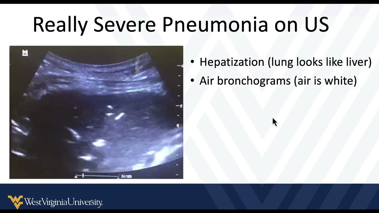 POCUS Findings in Pulmonary Infectious or Inflammatory Conditions