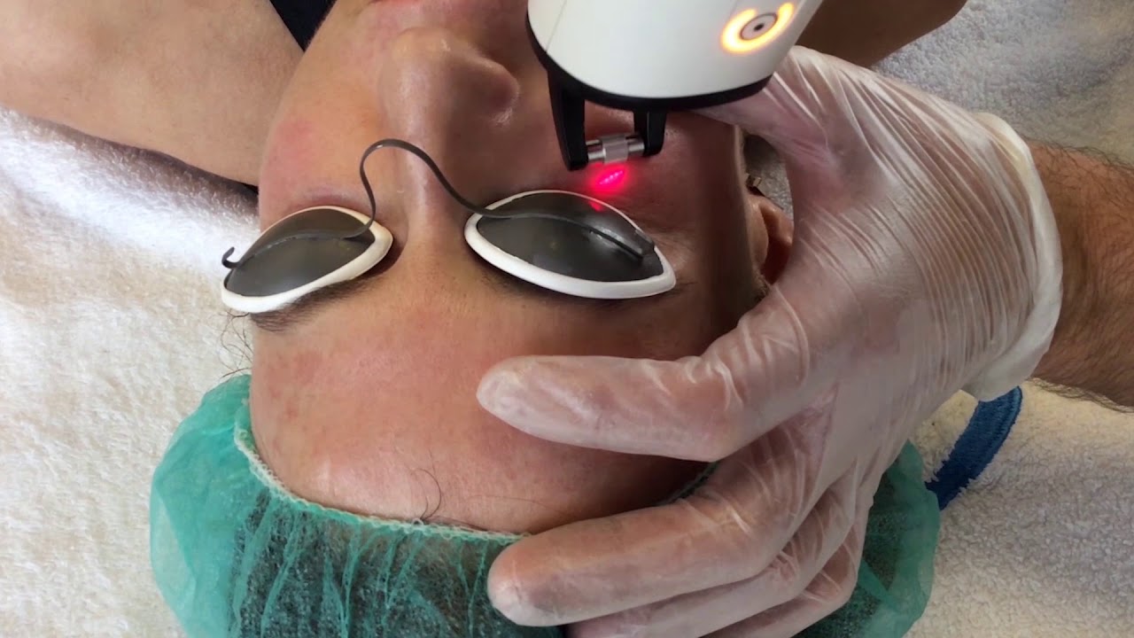 Resultado de tratamiento periocular con NAFL1550 para rejuvenecer y devolver frescura a la mirada