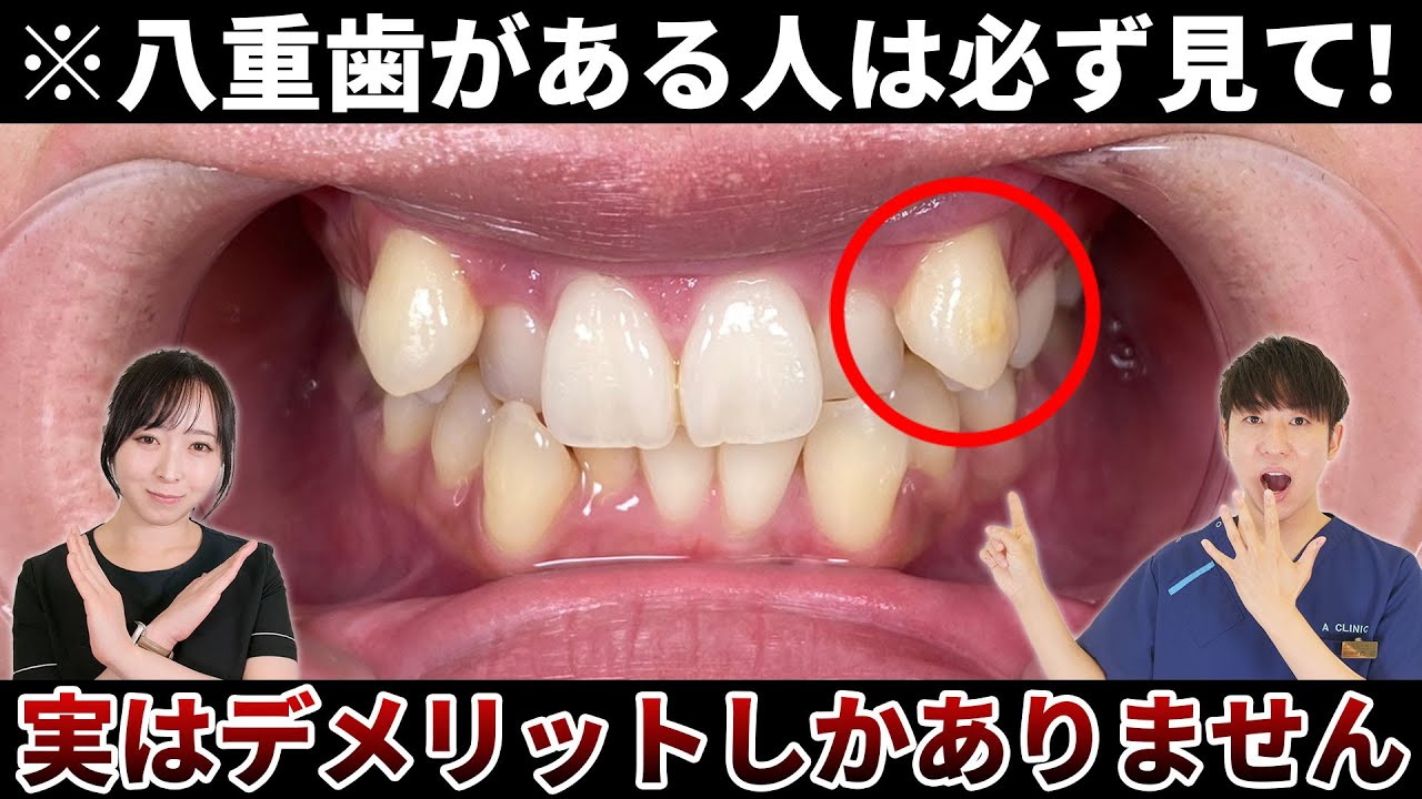 八重歯は可愛いけどデメリット！？　歯医者が教える真実！