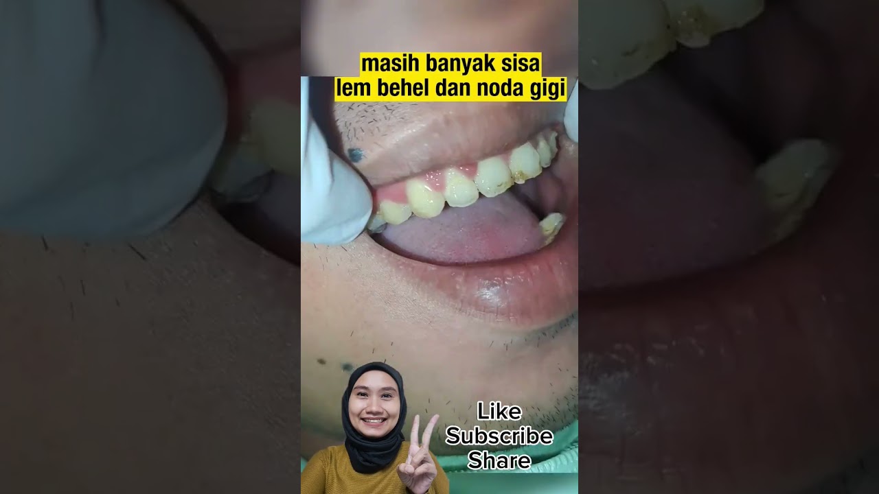 LEPAS BEHEL SELF LIGATING | SELFLIGATING #behel #behelgigi