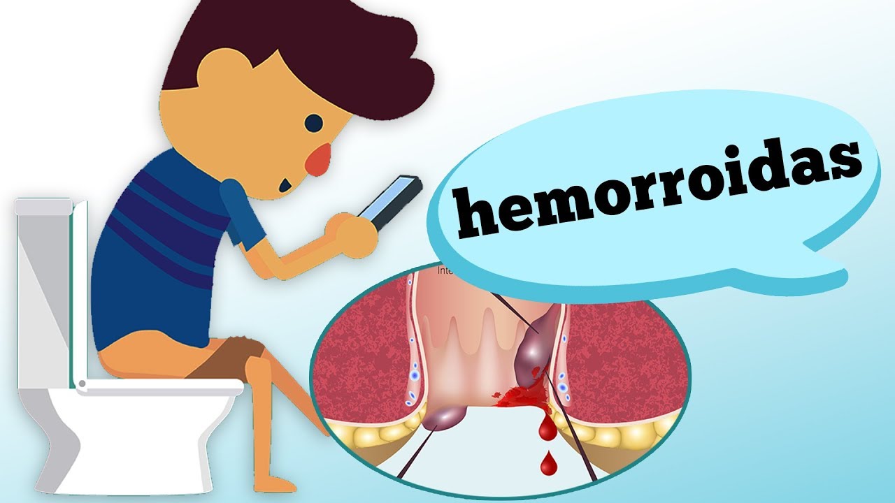 HEMORROIDAS: Quais os sintomas e caracter&iacute;sticas?