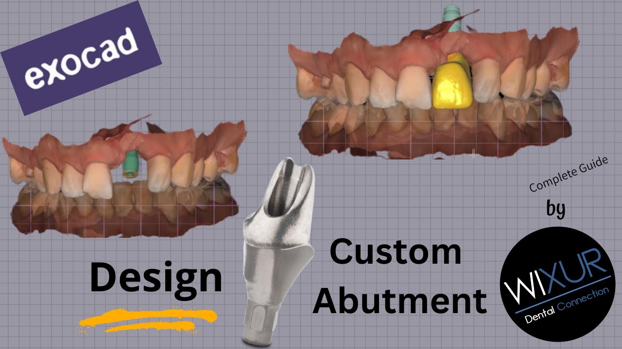 Design A Custom Abutment (Maxillary Anterior)