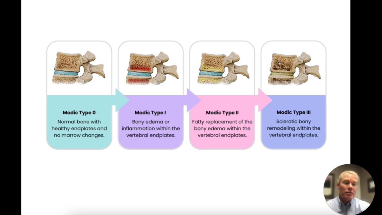 Demystifying Modic Changes | ChiroUp
