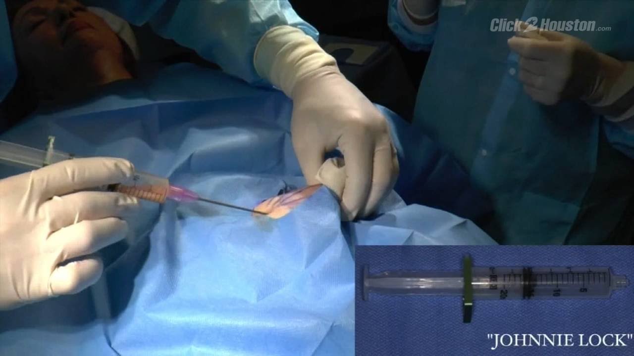 Using stem cells to stop hair loss