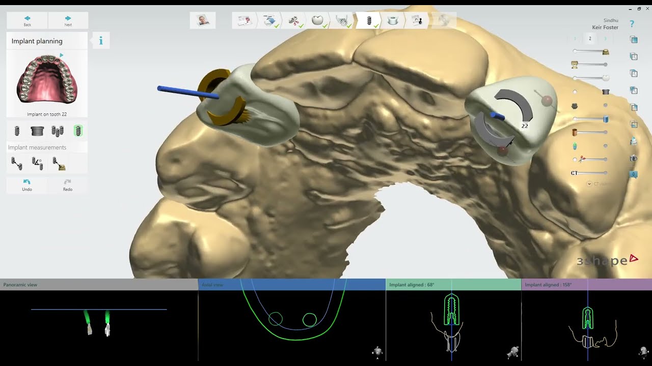 Digital Implant Dentistry Workflow Planning, Placement & Restoration at IMPRESS Perio Implant Center