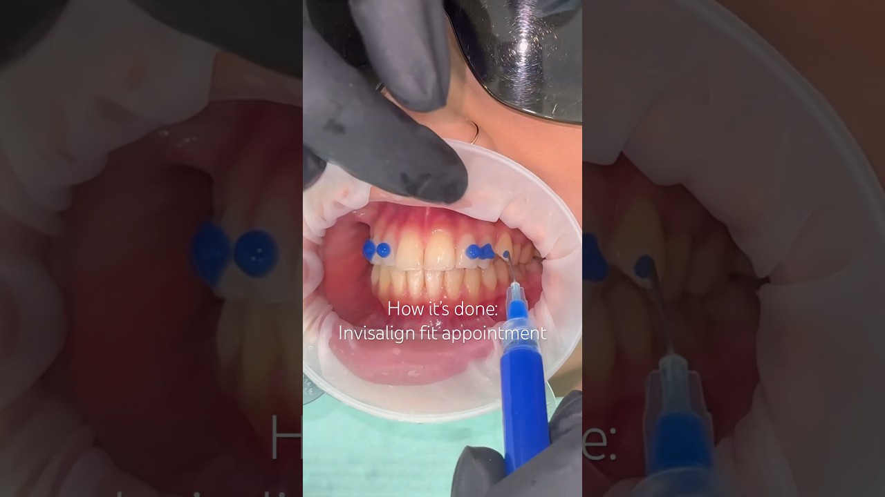 Invisalign fit appointment, including placing attachments 🙌 #Invisalign #orthodontist