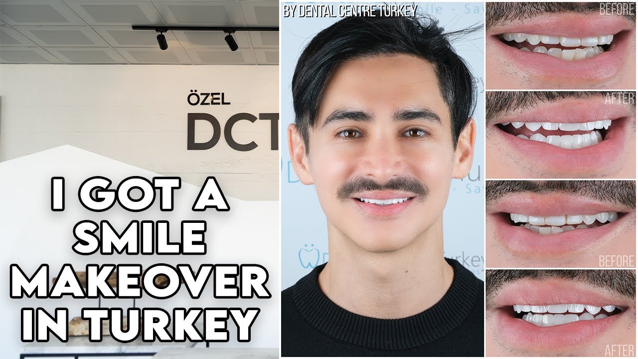 Getting Veneers in Turkey with the Dental Centre Turkey in Antalya
