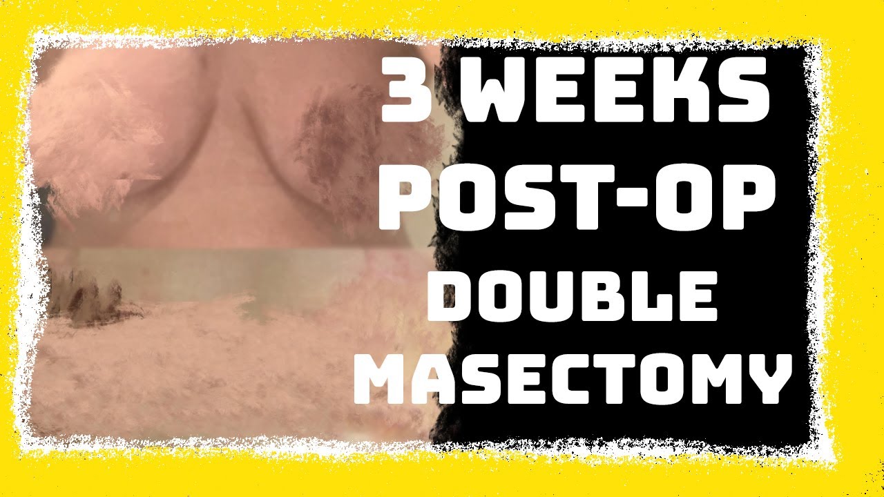 FTM- 3 WEEKS POST-OP (TOP SURGERY)