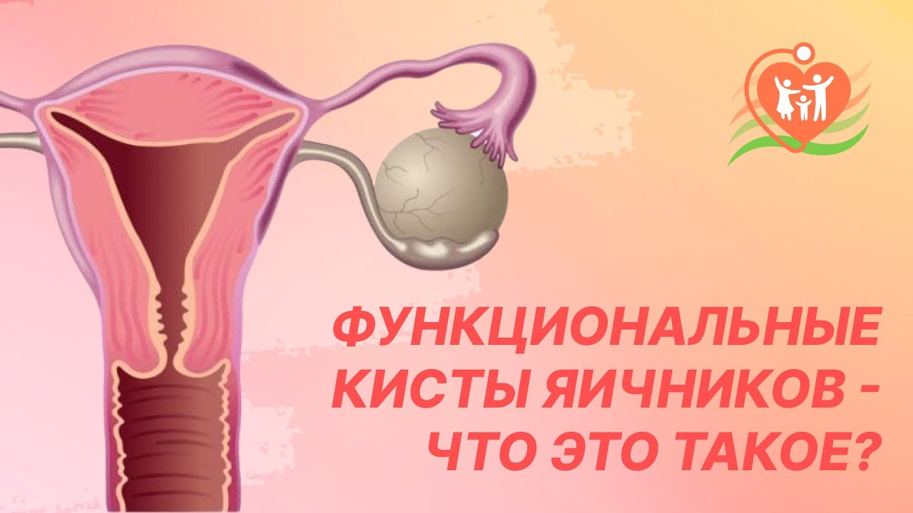 👉 Функциональные кисты яичников - что это такое?