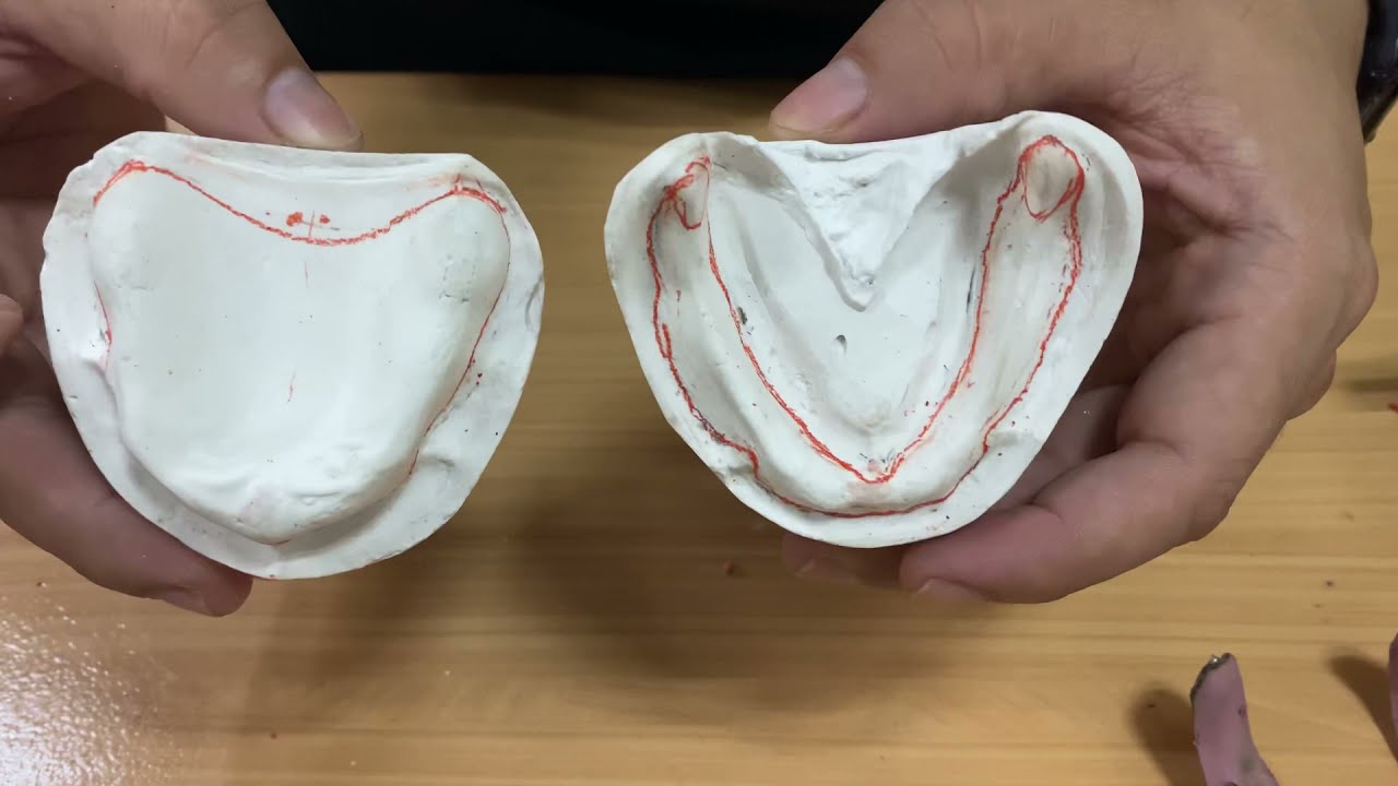 COMPLETE DENTURE - Custom tray fabrication