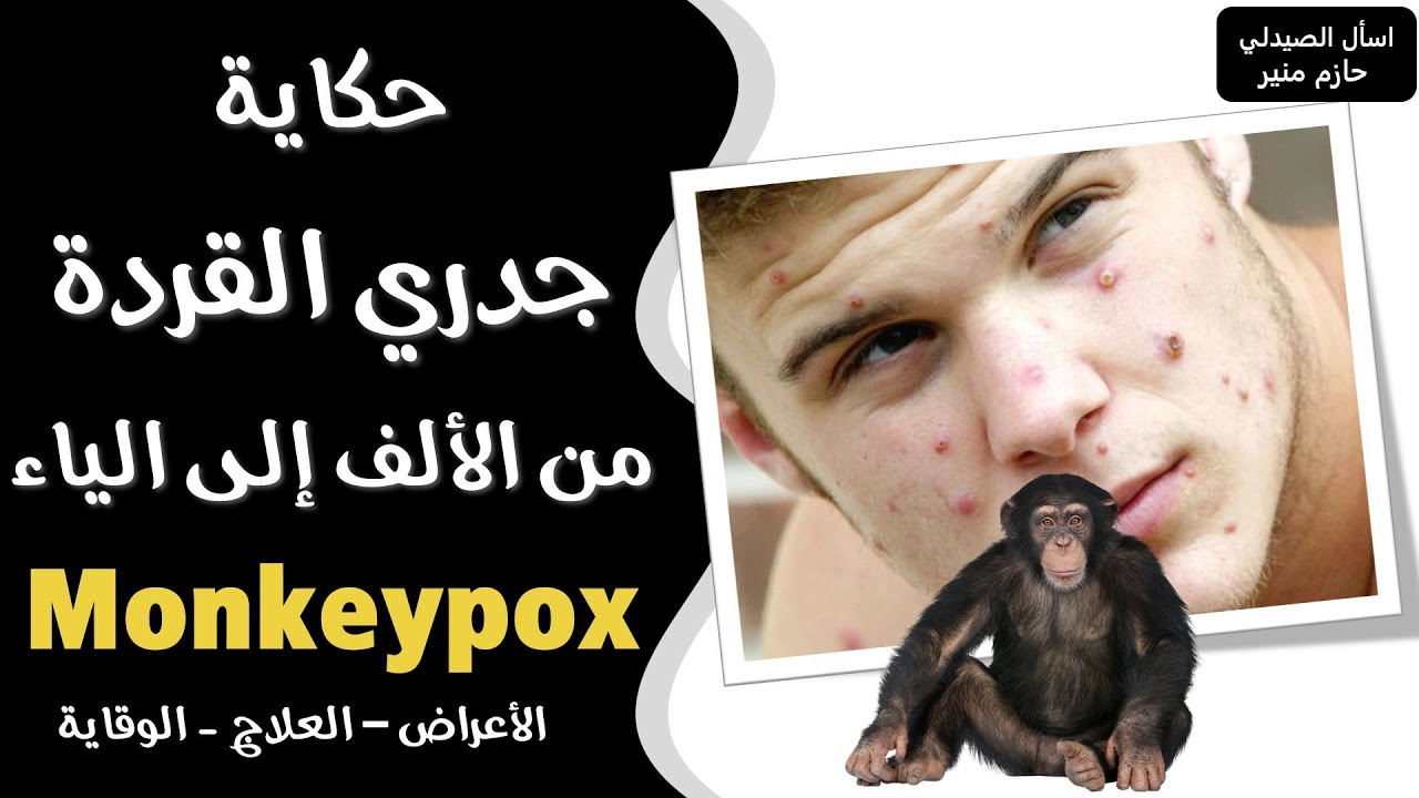 ما هو جدري القردة من الألف إلى الياء - جدري القرود - Monkeypox