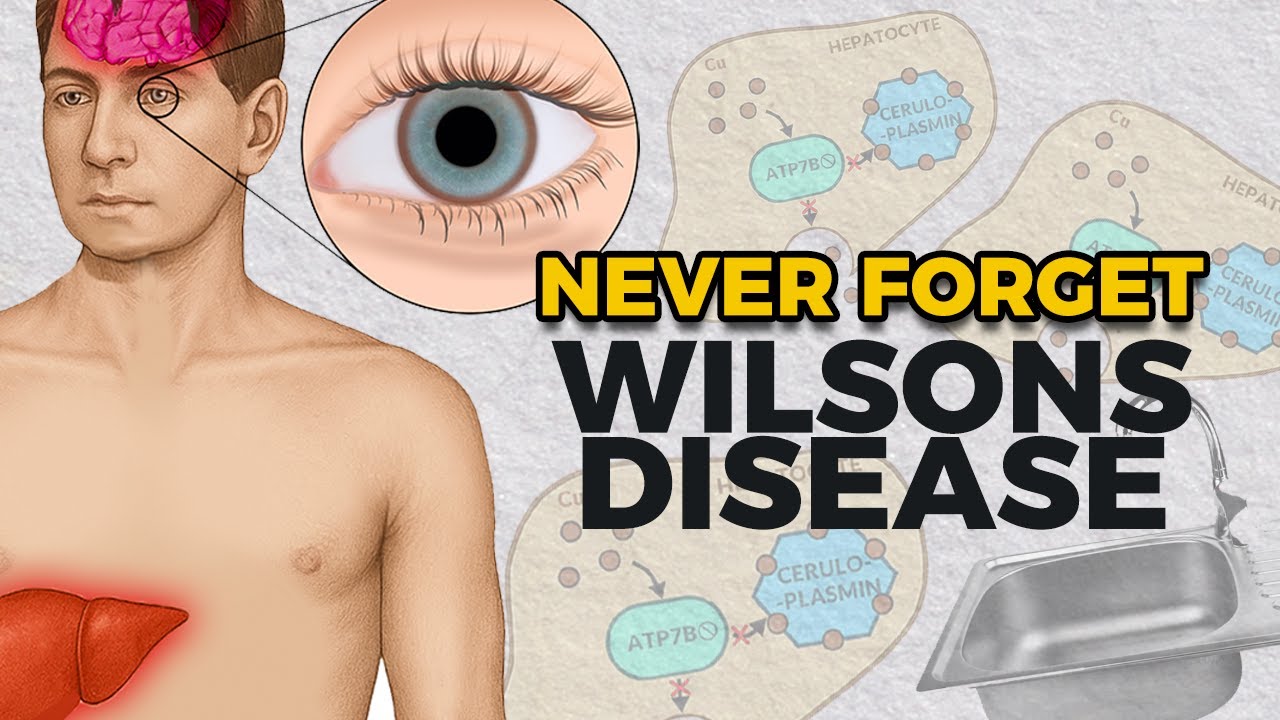Wilson's Disease: Everything You Need To Know (and how to never forget it)