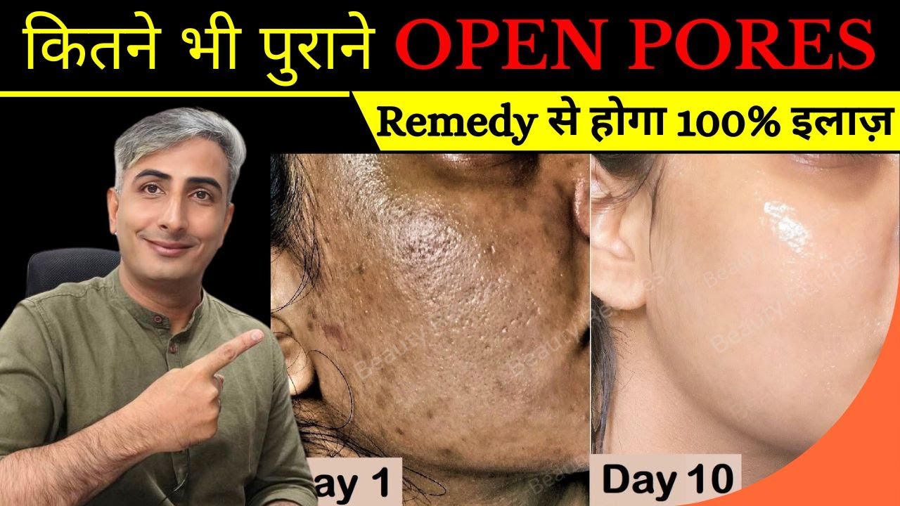 कितने भी पुराने OPEN PORES, LARGE PORES, CLOGGED PORES, इस Remedy से होगा 100% इलाज़ I DR. MANOJ DAS