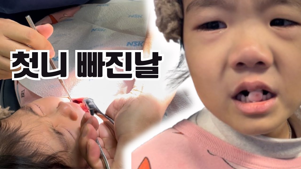유치빠지는시기 6살 첫니 발치 브이로그