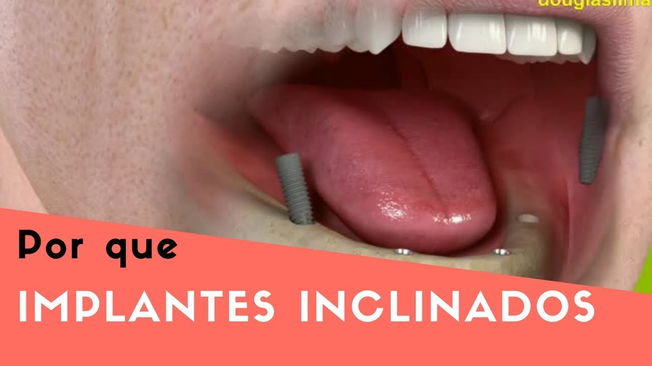 PRÓTESE PROTOCOLO INFERIOR COM IMPLANTES INCLINADOS