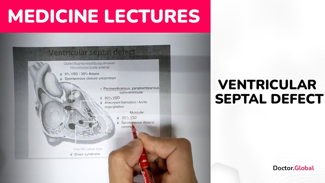 Ventricular Septal Defect (VSD) - Origin and Mechanisms of Development
