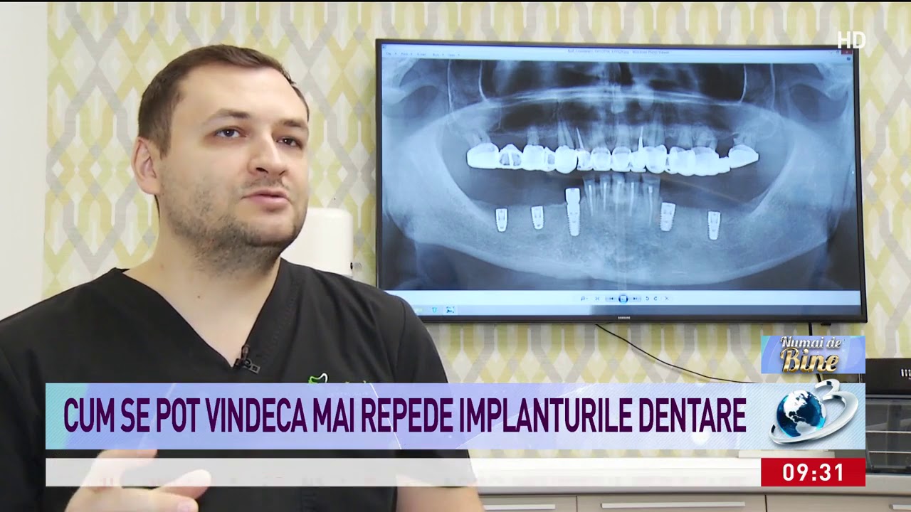 Cu PRGF, implantul dentar se vindeca de 7 ori mai repede