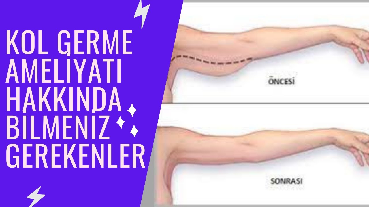 Kol Germe Ameliyatı Hakkında Bilmeniz Gerekenler !