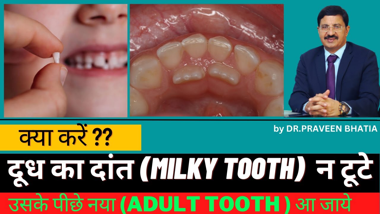 पीछे नया दांत आ गया ,दूध का दांत नहीं टूटा-क्या करें ?-New Tooth is Growing in Behind the Baby Tooth