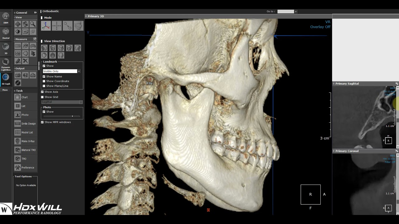 Ondemand3D - Extracting Ceph from CBCT Scan