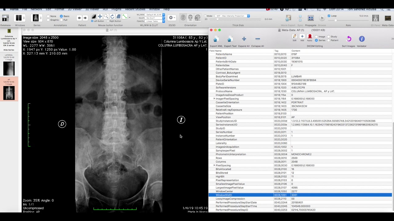 VISOR DICOM HOROS : OSIRIX 11 (exportación de casos y realización de informes)