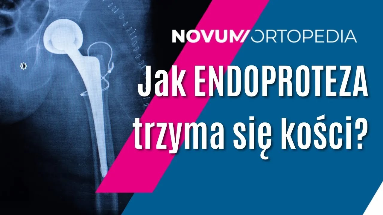 Dlaczego ENDOPROTEZA stawu biodrowego [tak dobrze!] TRZYMA się kości? | Novum Ortopedia