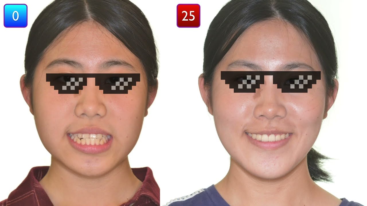 Class lll Malocclusion Treated with Insignia® System｜【Chris Chang Ortho】CC493