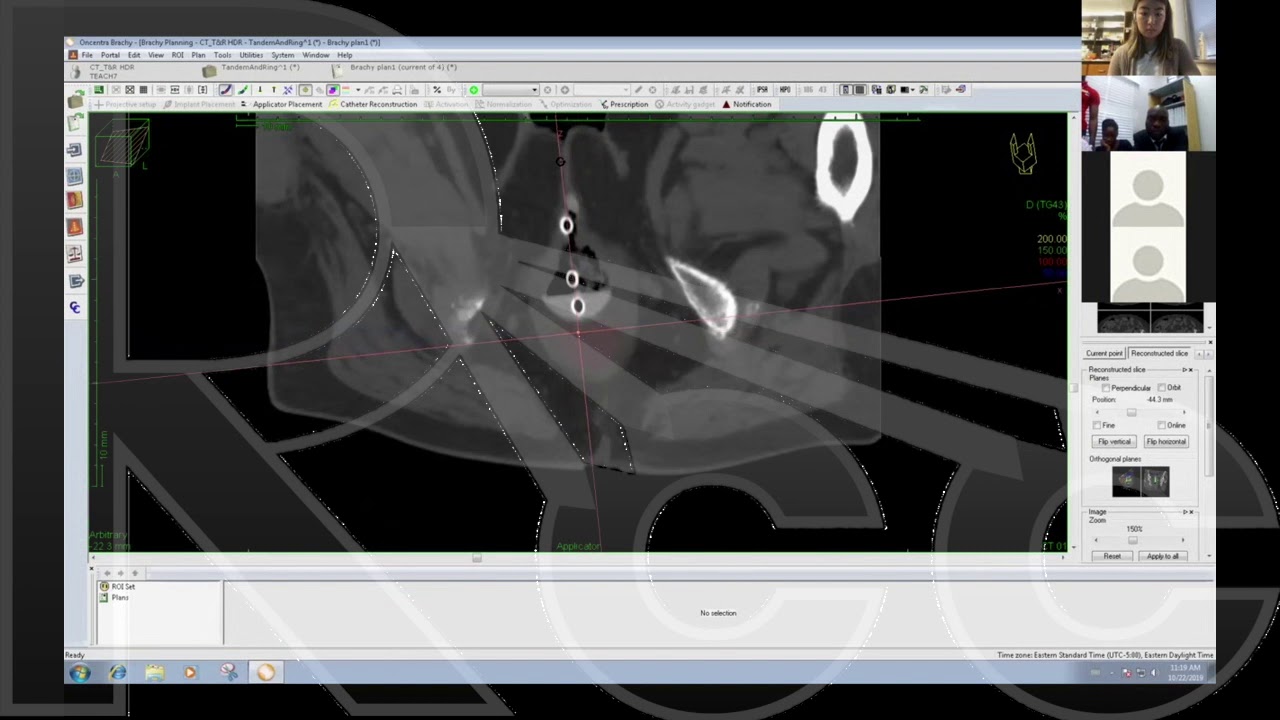 Rayos Contra Cancer HDR Brachytherapy Live Planning 2: T&R and T&O | Michael Tassotto