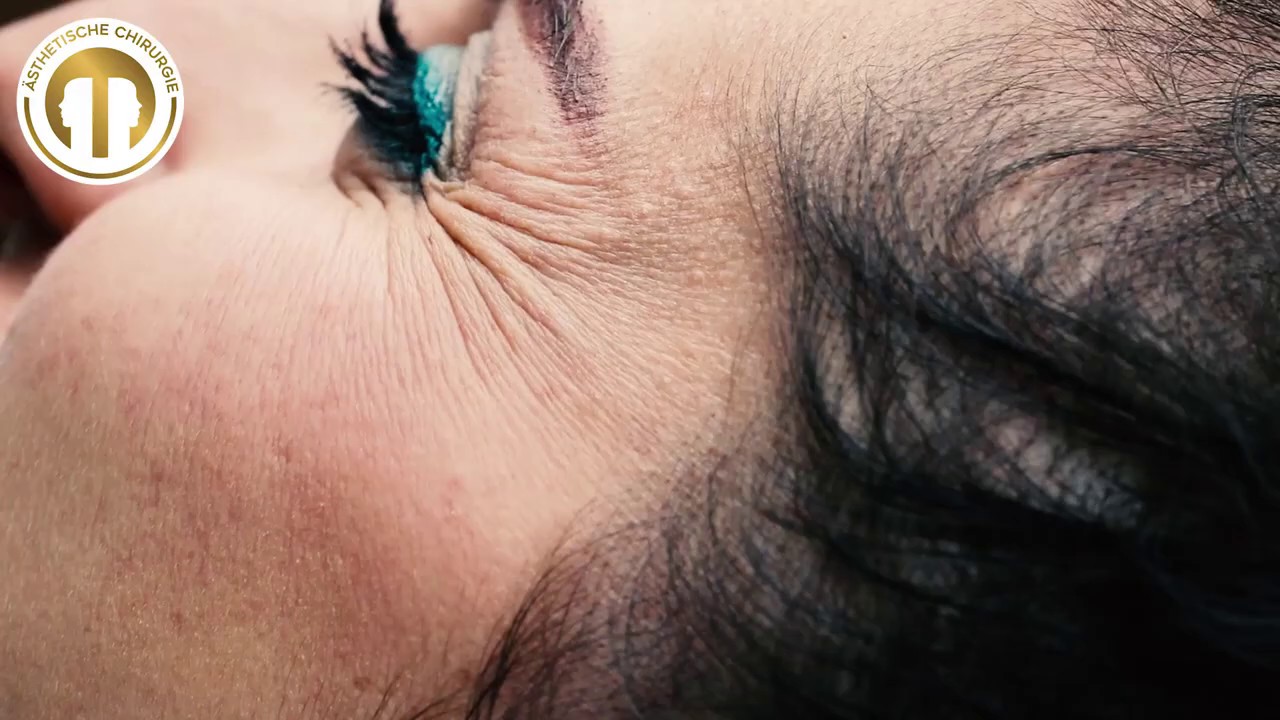 Krähenfüße entfernen mit Botox | vom Privatdozenten behandelt | Mc Aesthetics