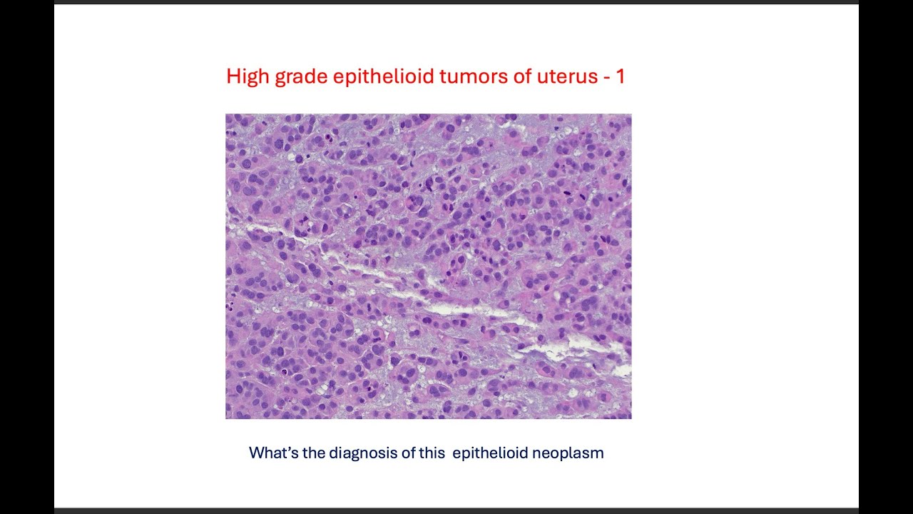 PATH ILLUMINATOR - GYN PATHOLOGY - Uterine mesenchymal tumors
