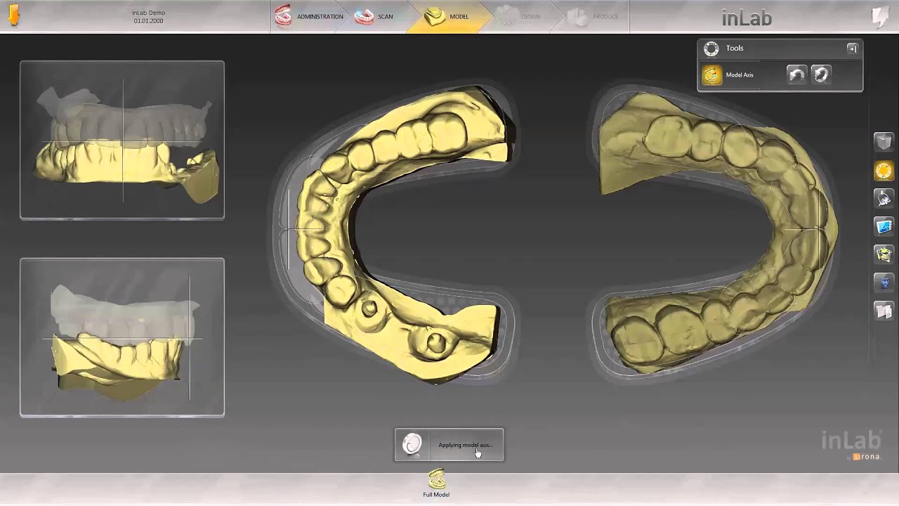 inLab SW 15: Multi-Unit Implant Bridge