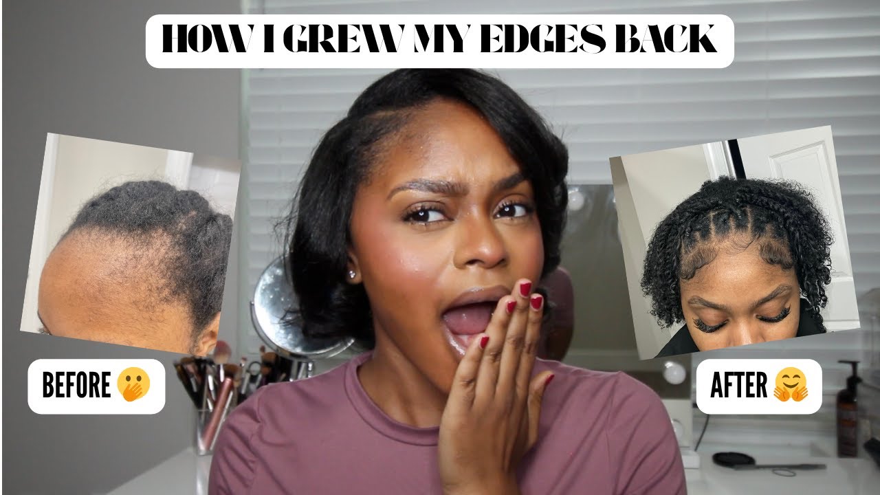 WIGS TOOK MY EDGES 😥 : HOW I GREW MY EDGES BACK FAST **EXTREME GROWTH** USING MINOXIDIL