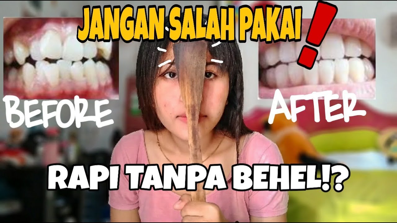MERAPIKAN GIGI TONGGOS TANPA BEHEL!?!