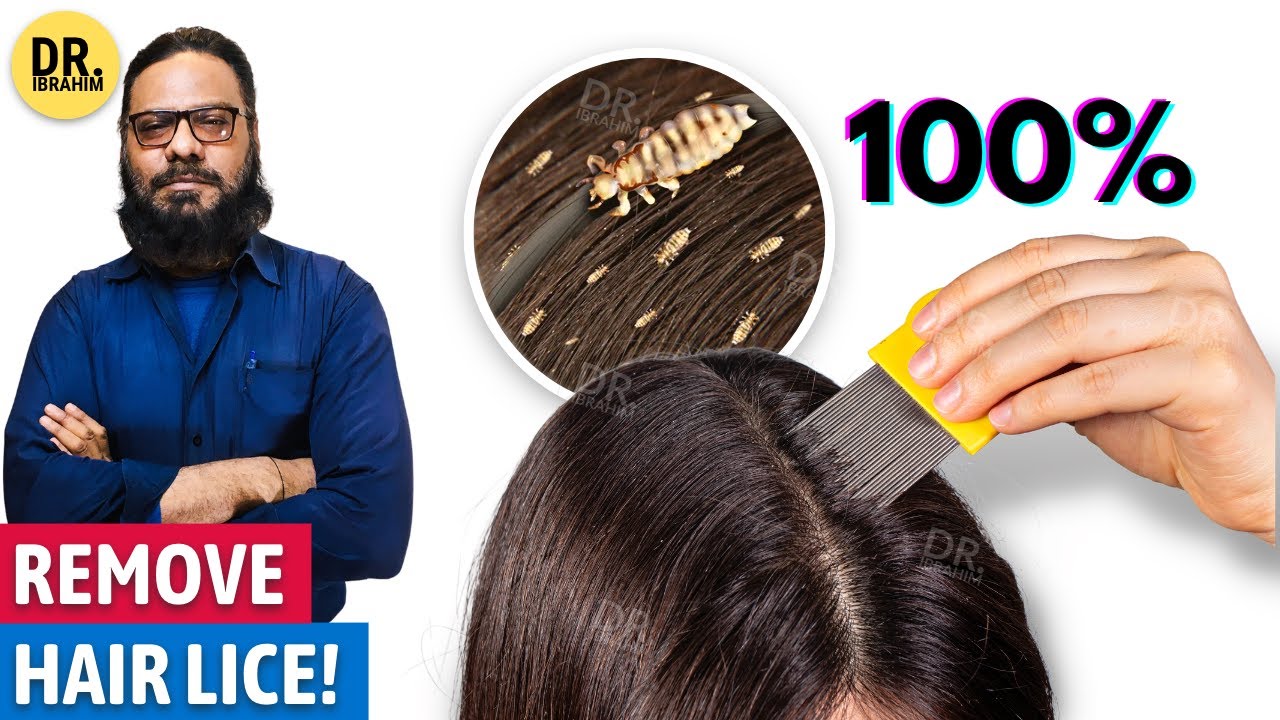 100% Hair Lice Removal | Sar Ki Juon Ka Ilaj | Urdu | Dr. Ibrahim