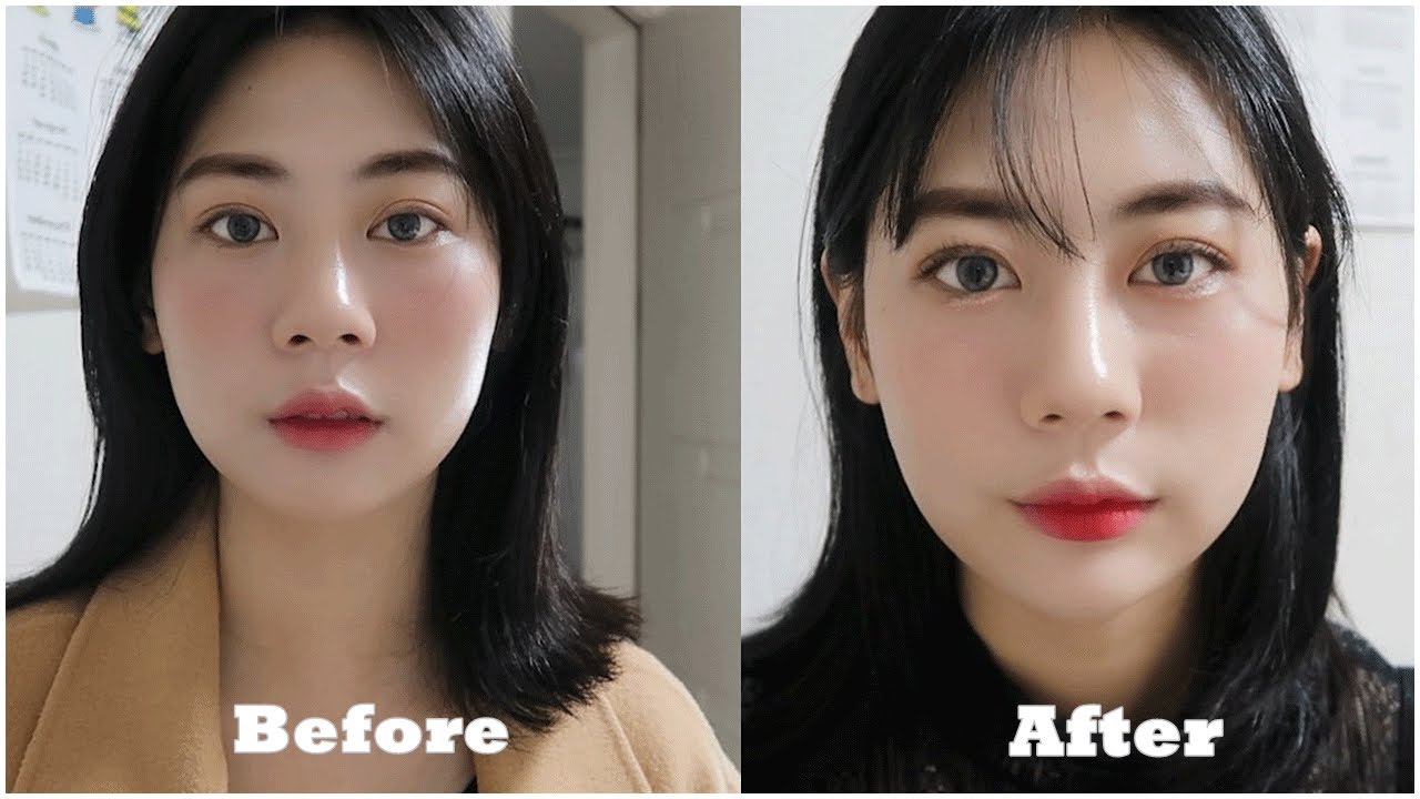인생 첫 필러 시술 🙆&zwj;♀🏥 턱끝 필러 무턱필러 후기 (상담과정, 비포애프터,주의사항)
