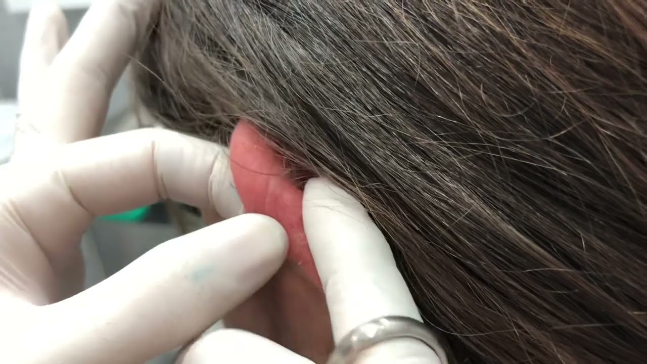 Piercing Helix y joyeria no indicada para la zona.